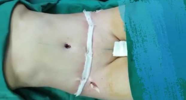 اینم شکم مامان بنده بعد از خارج کردن چربی هاش