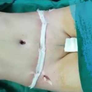 اینم شکم مامان بنده بعد از خارج کردن چربی هاش
